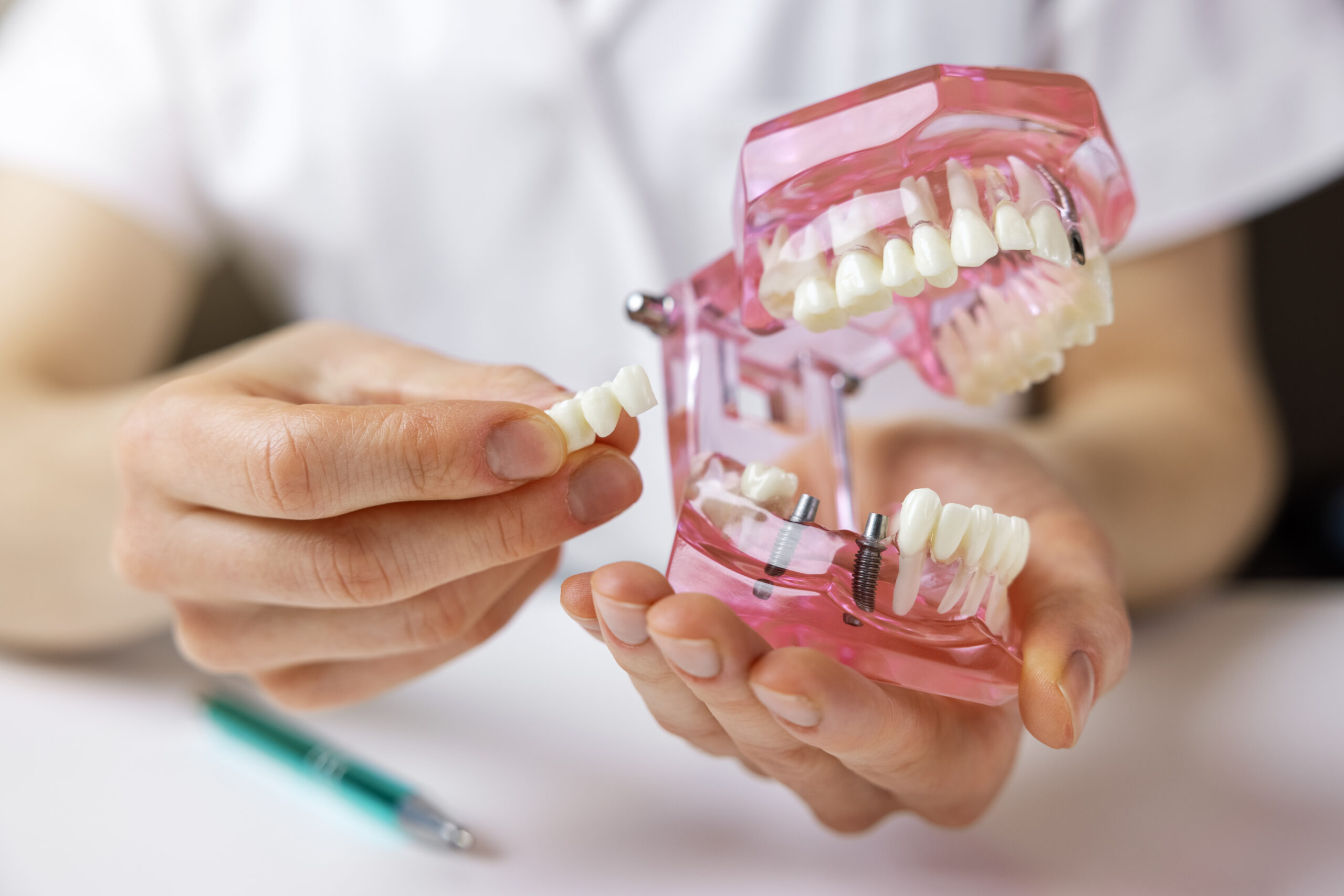 Implantologia dentale a carico immediato Venezia